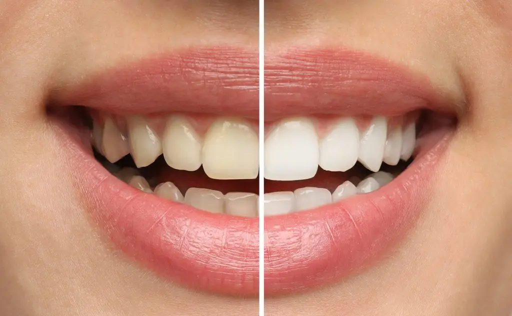 collage with photos of woman before and after teeth whitening, c